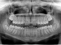 Jak działa aparat ortodontyczny?